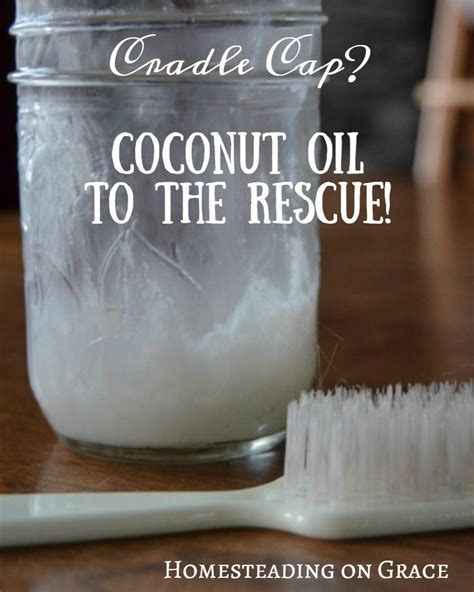 Coconut Oil To The Rescue Cradle Cap Cradle Cap Remedies Baby