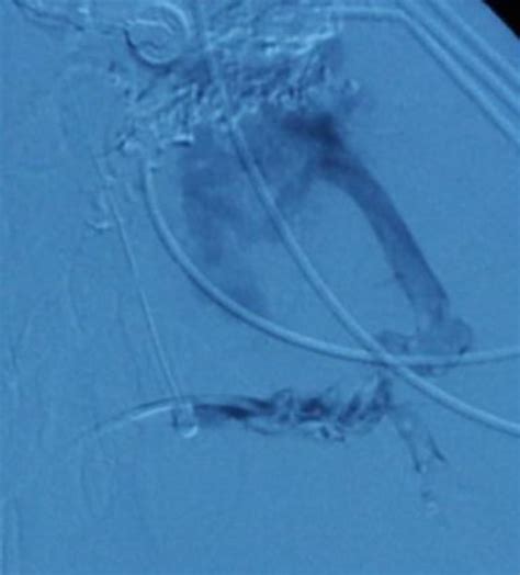 Percutaneous Transhepatic Portography Showed Obstruction Of The Splenic