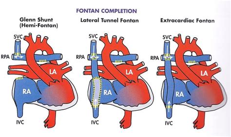 Left To Right Shunt Lesions Atrial Septal Defect Asd Atrial Septal