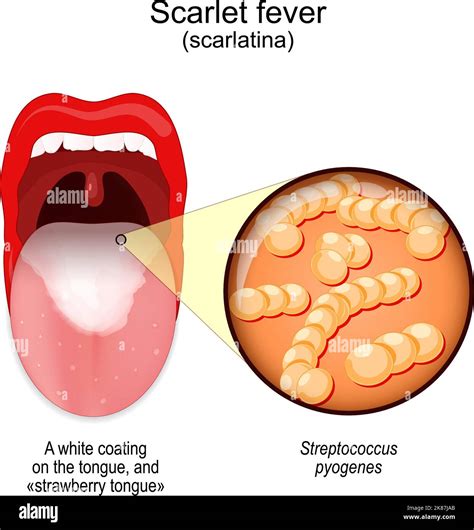 Scarlet fever. symptoms of scarlatina. Mouth with white coating on the ...