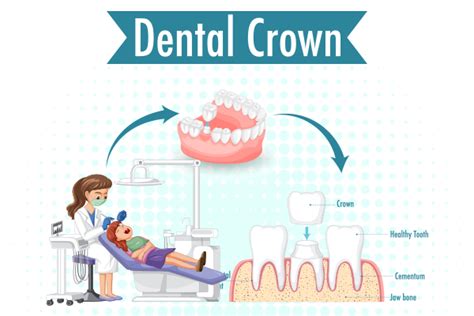 Partial Dentures Cost Treatment Types In India