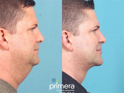 Submentoplasty Chin Implant Neck Lift Orlando FL