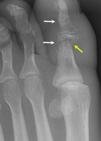 Osteomyelitis In Foot And Ankle Om Oc Foot And Ankle Clinic