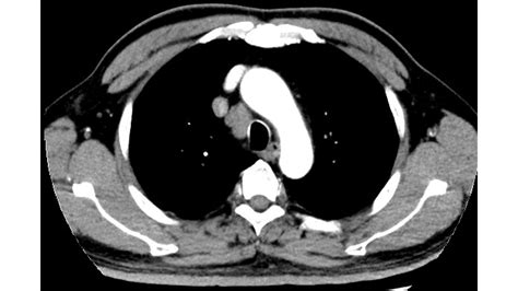 纵隔支气管囊肿 中国医学影像联盟 China Medical Imaging Association