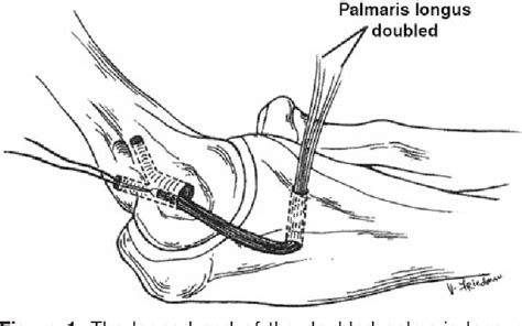 Figure 1 From The Modified Docking Procedure For Elbow Ulnar Collateral Ligament Reconstruction