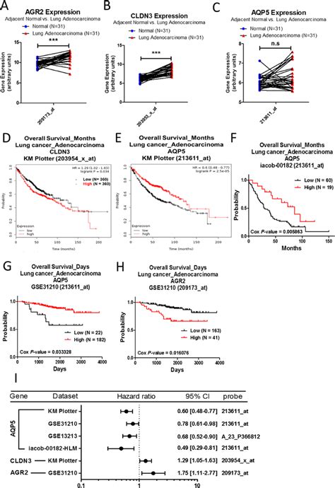 Analysis Of Agr2 Cldn3 And Aqp5 In Clinical Lung Adenocarcinoma