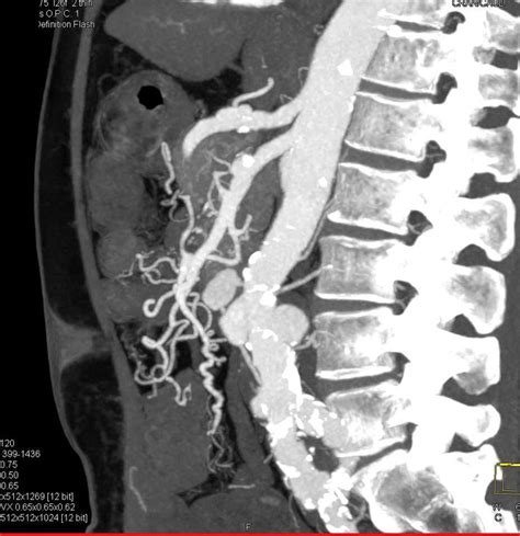 Celiac Artery Dissection And Vasculitis Vascular Case Studies