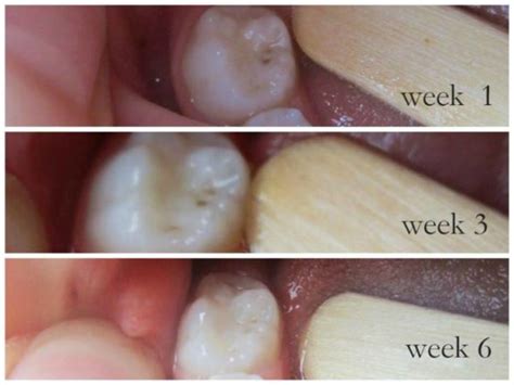 More Photographic Proof Cavities Heal | Healthy Home Economist