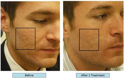 Dr Balikian Treats Acne Scars Balikian Plastic Surgery