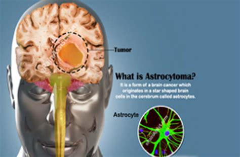 Astrocytoma