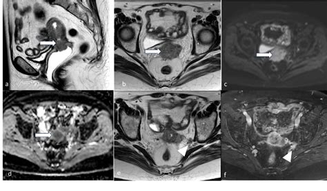 Figure 11 from Endometrial Cancer: 2023 Revised FIGO Staging System and ...