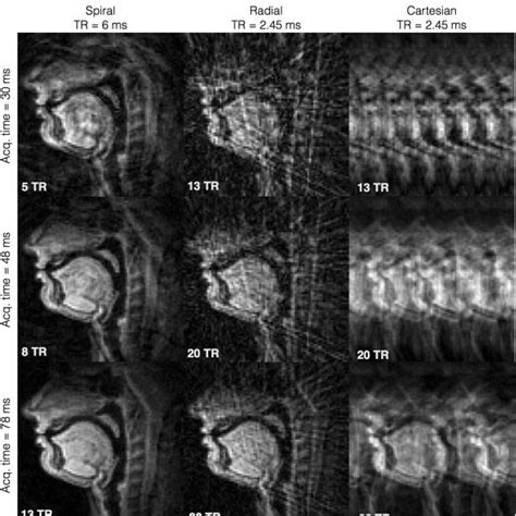 Simulated Aliasing Artifacts For Spiral Radial And Cartesian