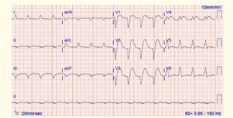 b: Sinus rhythm. Left axis deviation. Left bundle branch block.... | Download Scientific Diagram