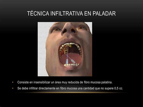 Tecnicas De Anestesia Troncular En Odontologia 10