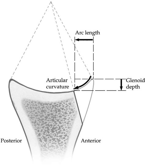 Bankart Fractures | Semantic Scholar