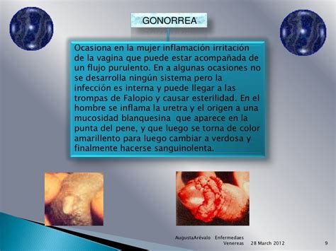 Diapositivas Enfermedades Venereas