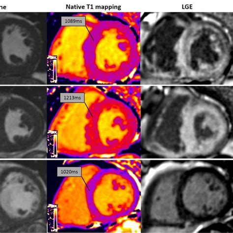 Native T1 Lge And Ecv In Attr Amyloidosis Short Axis Ssfp Cine Right