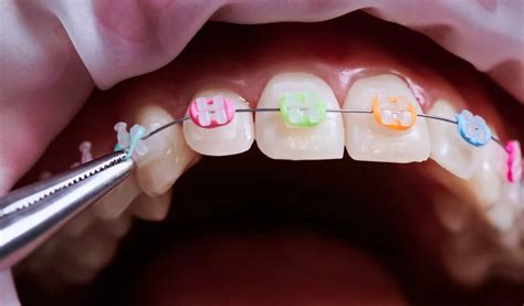 How Rubber Bands For Braces Help Align Your Teeth During Treatment Dental Health Clinic