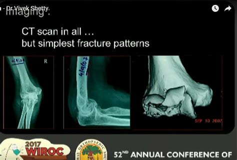 Pearls and Pitfalls in Capitellum fracture fixation ...