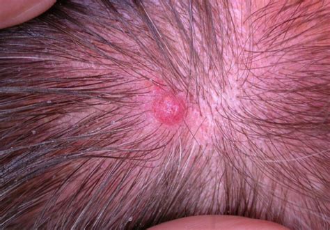 Melanoma Pictures Scalp Symptoms And Pictures