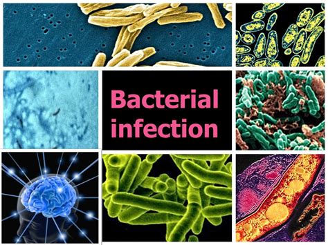 Ppt Cns Infections Powerpoint Presentation Free Download Id2398688