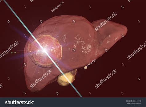 Liver Cancer Treatment Laser Conceptual Image Stock Illustration