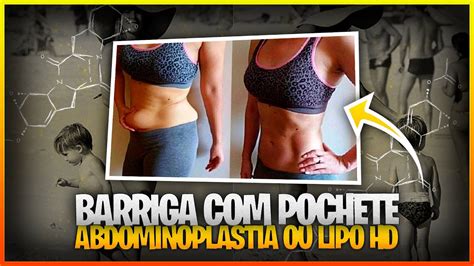 Barriga Pochete Abdominoplastia Ou Lipo Hd Youtube