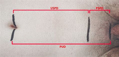 Clinical Anatomical Measurements Uspd—the Distance Between Umbilicus