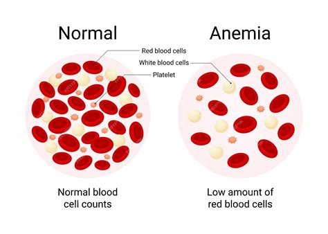 O Que Significa Anemia - Premium Vector | Overview of Normal Blood and Anemia