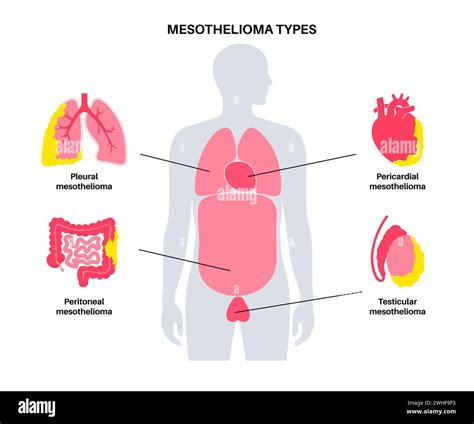 Mesothelioma Tumour Types Illustration Stock Photo Alamy