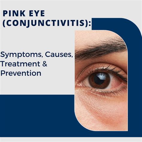 Pink Eye (Conjunctivitis): Symptoms, Causes, Treatment, & Prevention ...