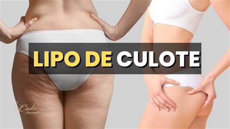 Culote Onde Fica Como Retirar Aprenda Agora Como A Lipo Pode