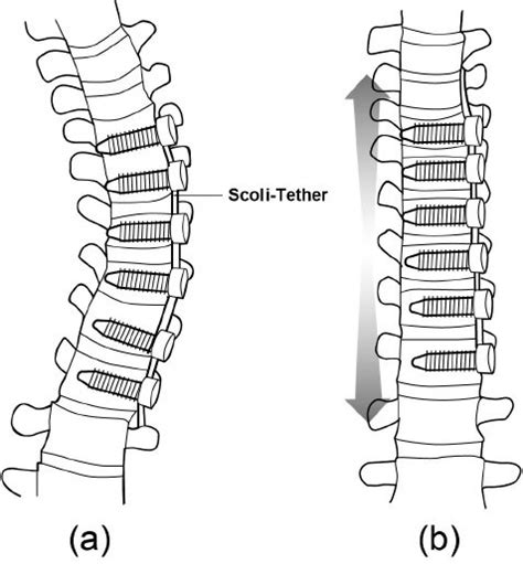 The Anterior Vertebral Tethering Approach This Involves Anchoring A