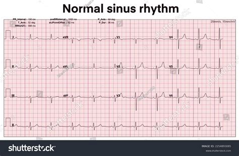 El Electrocardiograma Muestra Un Ritmo Sinusal Ilustración De Stock 2254893085 Shutterstock