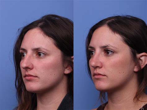 Rhinoplasty Before And After Pictures Case 409 Scottsdale And Phoenix