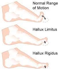 Hallux Rigidus - Orthotics - Eddie O'Grady Physiotherapist