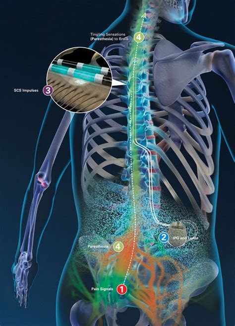 Abbott Spinal Cord Stimulator Manual