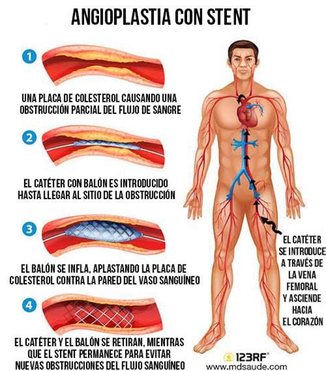 CATETERISMO CARDÍACO Angioplastia con Stent MD Saúde