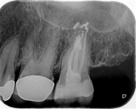 Zahn 27 Interne Resorption Apikale Aufhellung WURZELSPITZE