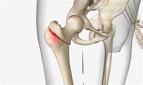 Premium Photo | A pertrochanteric fracture is a hip fracture that is ...