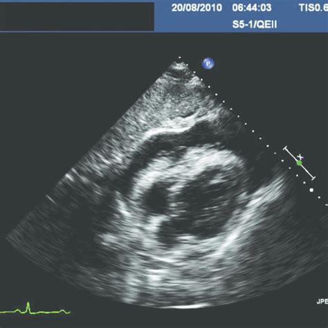 Echocardiogram illustrating moderate-sized pericardial effusion with... | Download Scientific ...