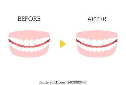 16 Before After Images Dental Veneers Royalty-Free Images, Stock Photos & Pictures | Shutterstock