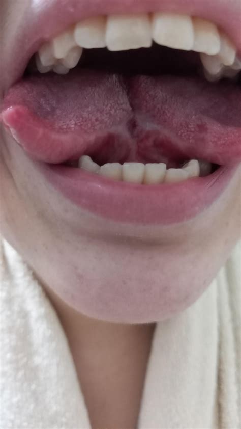 Tongue Split 1 Month Update R Bodymods