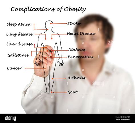 Obesity complications hi-res stock photography and images - Alamy