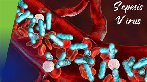 Sepsis Symptoms Causes And Prevention