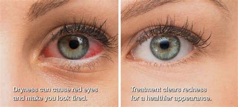 Dry Eyes Chicago - Midway - Garfield Ridge - Dry Eye Treatment ...