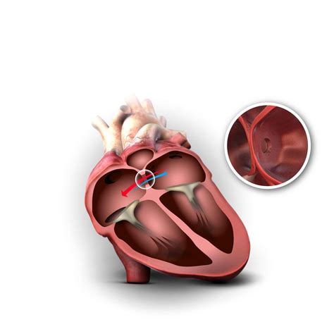 Heart Defect ASD - Occlutech - Every beat counts