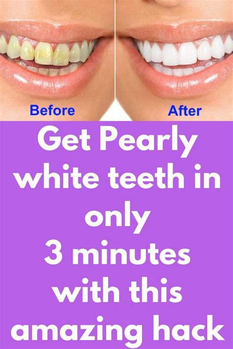 Pin On Teeth Whitening