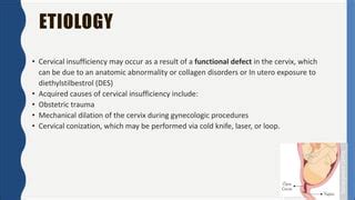 Cervical Incompetence (insufficiency) | PPT