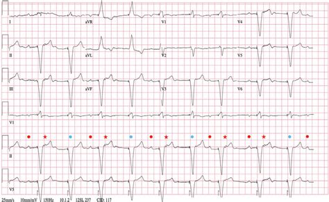 Admission Electrocardiogram Showing Normal Sinus Rhythm Red Dots With